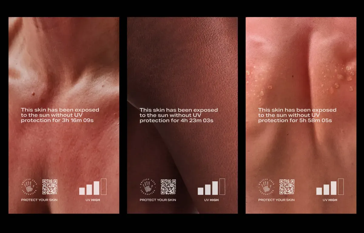 British Skin Foundation — This skin has been exposed