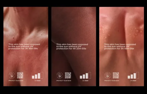 British Skin Foundation — This skin has been exposed